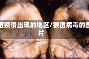 猴痘疫情出现的地区/猴痘病毒的图片
