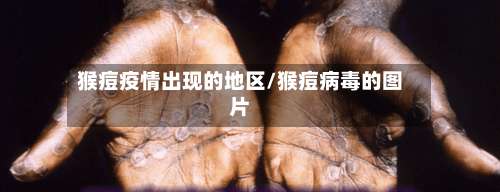猴痘疫情出现的地区/猴痘病毒的图片-第1张图片
