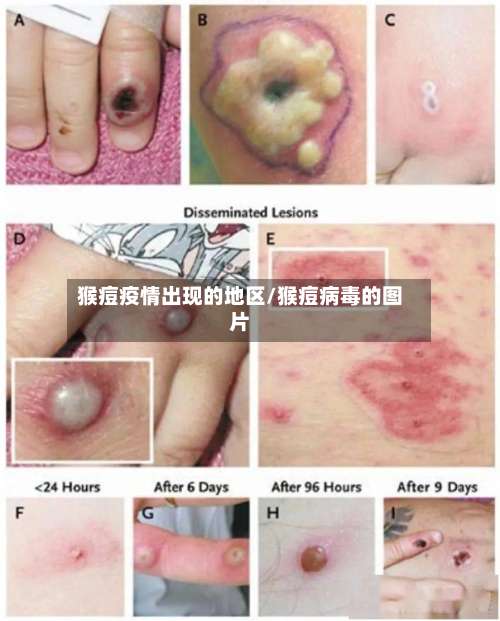 猴痘疫情出现的地区/猴痘病毒的图片-第3张图片